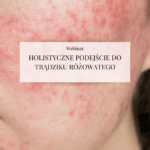 Webinar "Holistyczne podejście do trądziku różowatego"